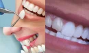 Lamine Diş Nedir ve Hangi Amaçla Uygulanır?