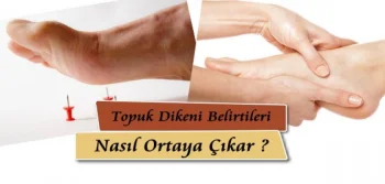 Topuk Dikeni Belirtileri Nasıl Ortaya Çıkar